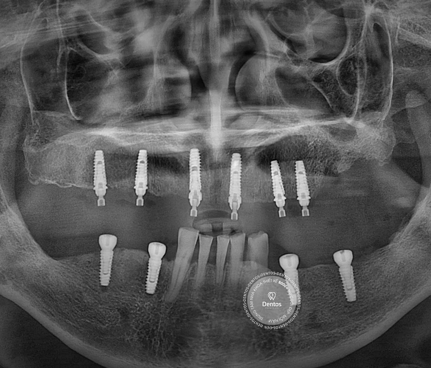 Trồng răng sứ có đau không? Cách giảm đau hiệu quả?
